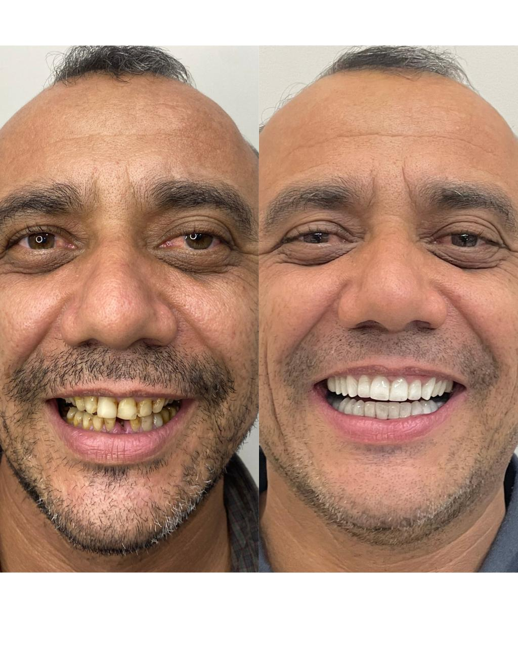 Antes e depois - Cícero